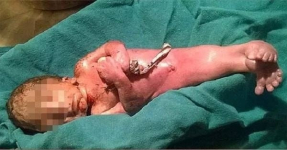 В Индии родился ребенок-"русалочка" (фото)