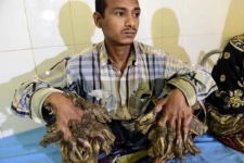 В Бангладеш прооперировали "человека-дерево" с жуткими наростами на руках (фото)