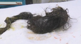 В Таразе хирурги нашли в желудке девочки больше килограмма волос