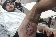В Австралии мужчина лишился кожи после взрыва iPhone в кармане (фото)