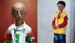 Из-за страшной болезни 15-летний индиец выглядит как старик (фото)