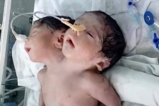 В Индии родился ребенок с двумя головами (фото)